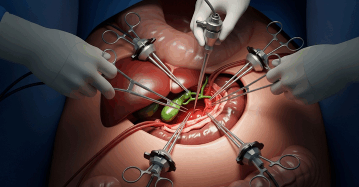 laparoscopic-cholecystectomy
