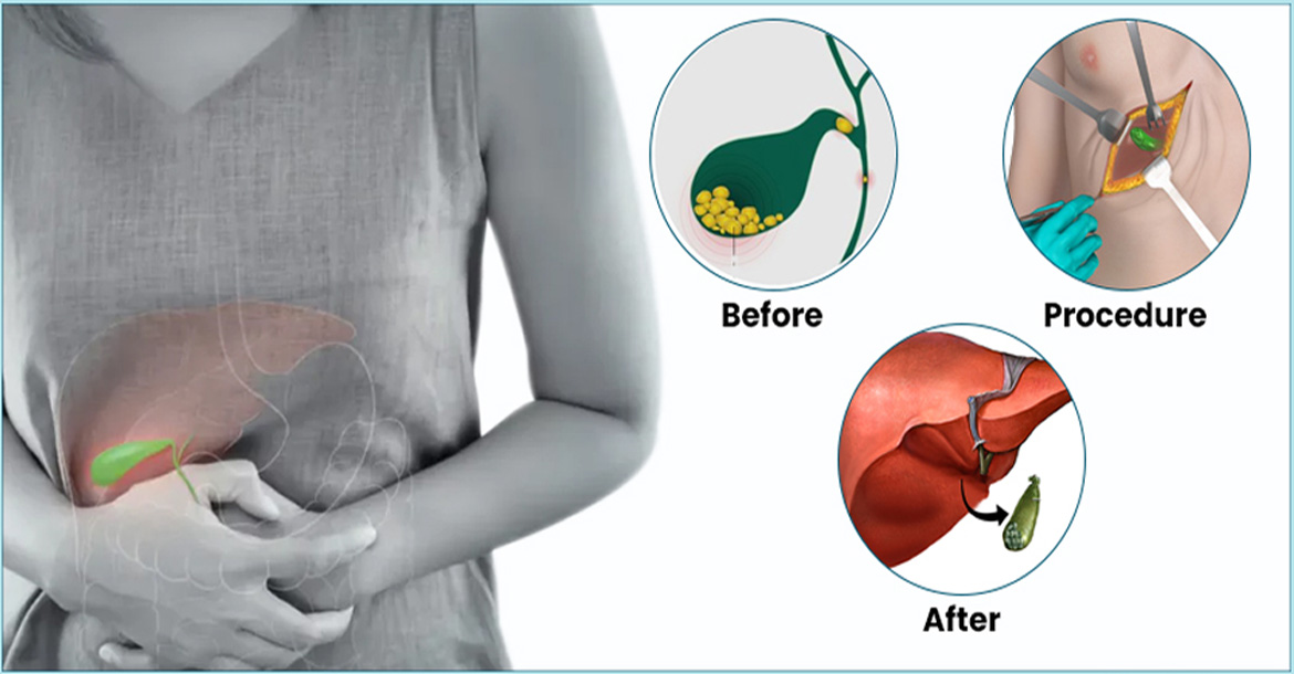 open-cholecystectomy