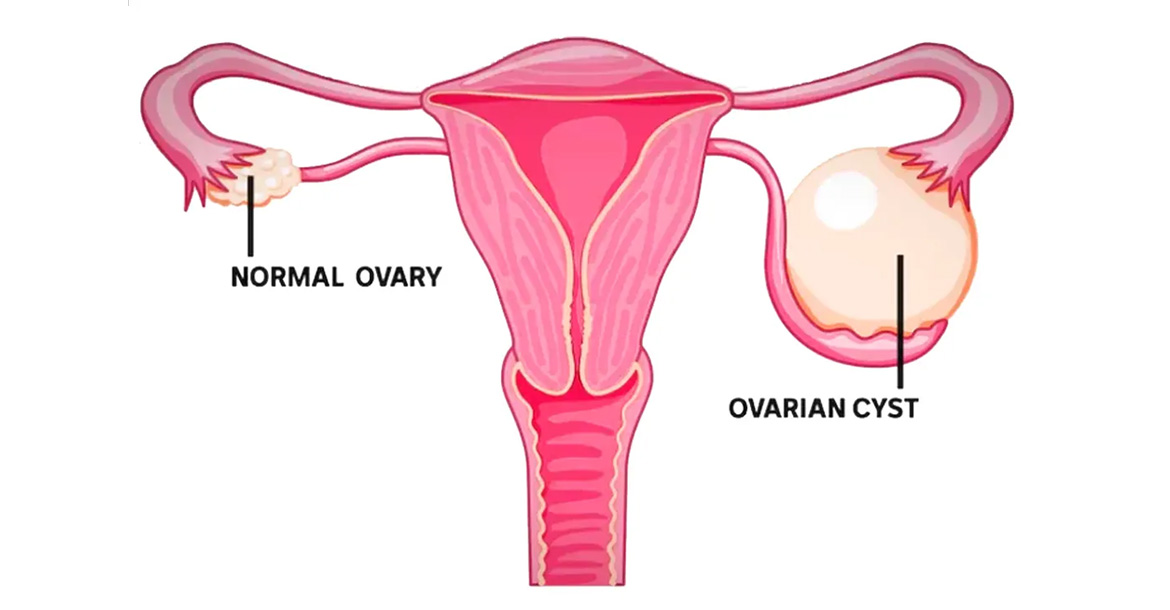 ovarian-cystectomy
